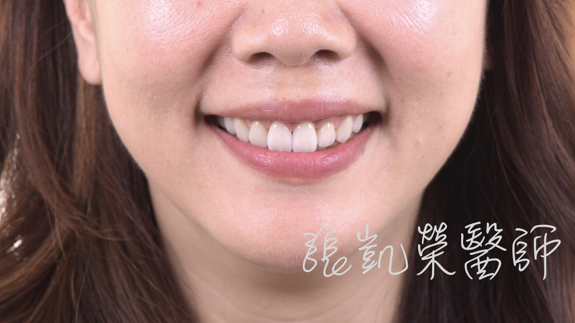 全瓷冠、貼片該怎麼選擇呢？