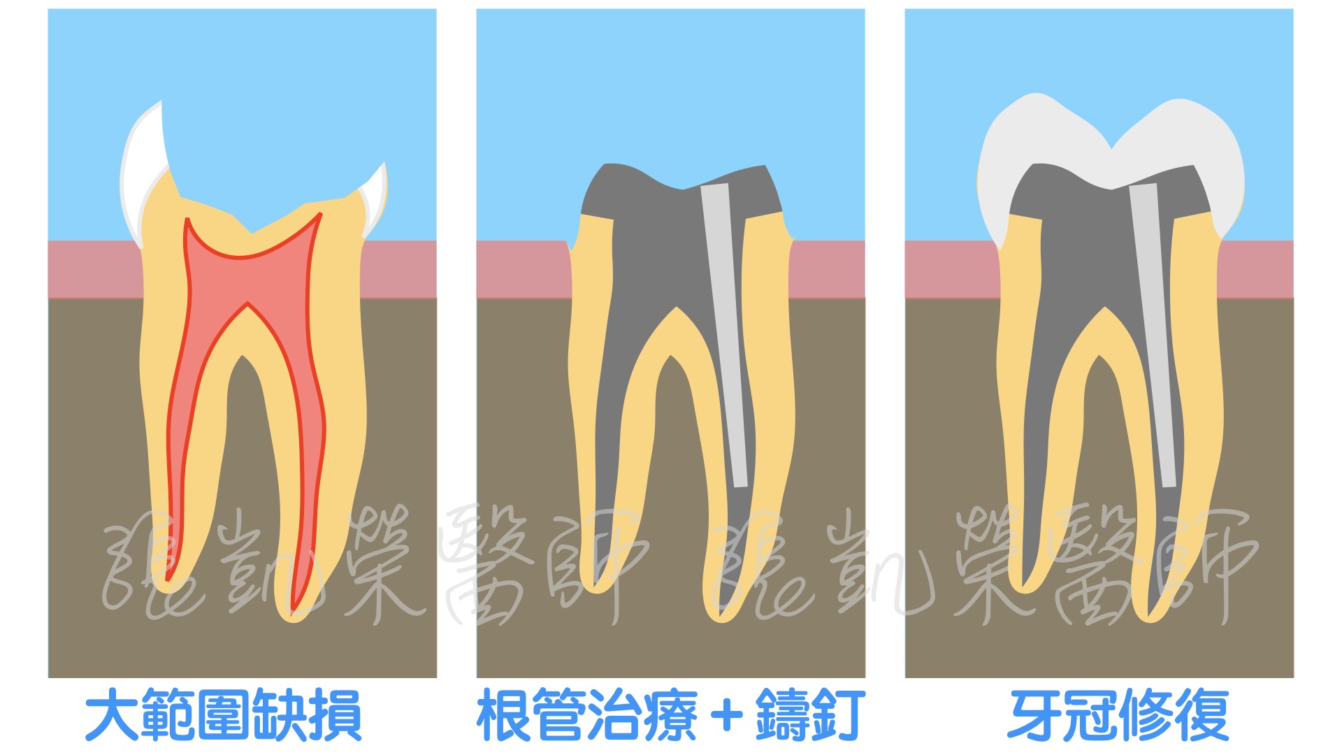 大範圍蛀牙怎麼辦呢？ part I：填補好嗎？做假牙好嗎？