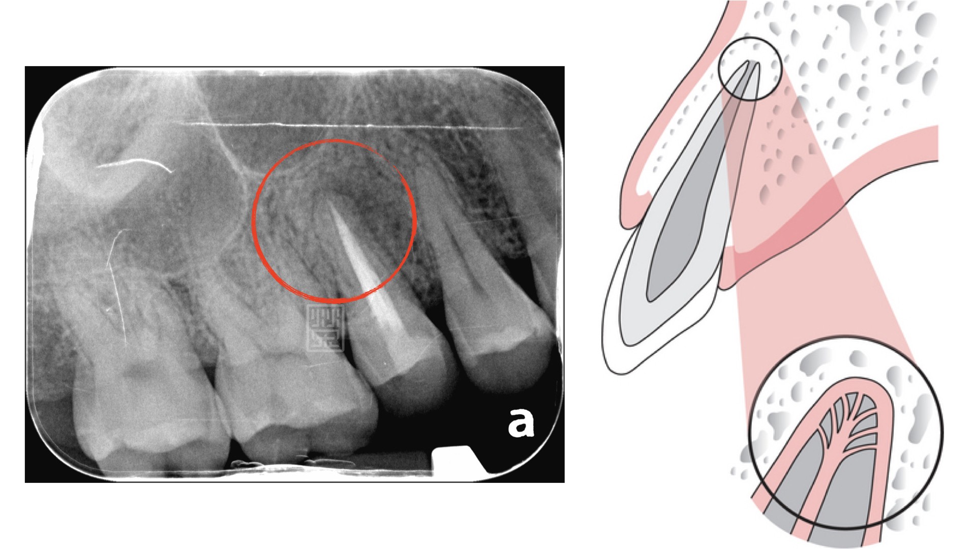 時間會說話四------根管治療後的牙齒突然痛起來了