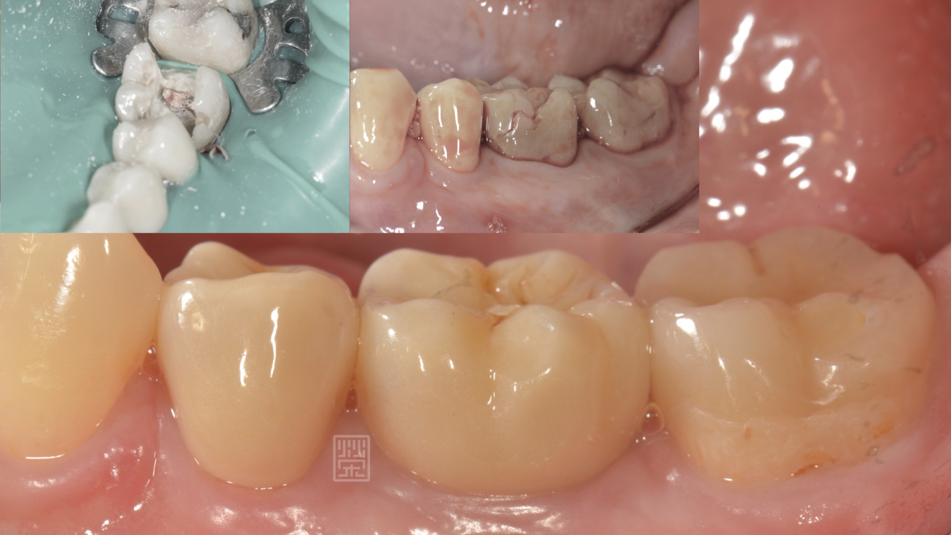 時間會說話二------根管治療後牙齒裂掉了！！！