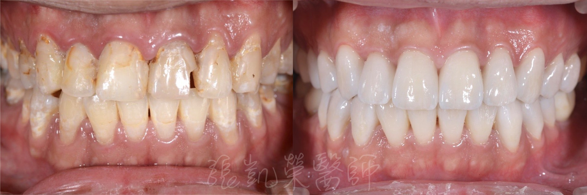 為什麼每次看牙，都有新蛀牙？感覺是永無止境的蛀牙，以後是否就要抽神經、拔牙、植牙了