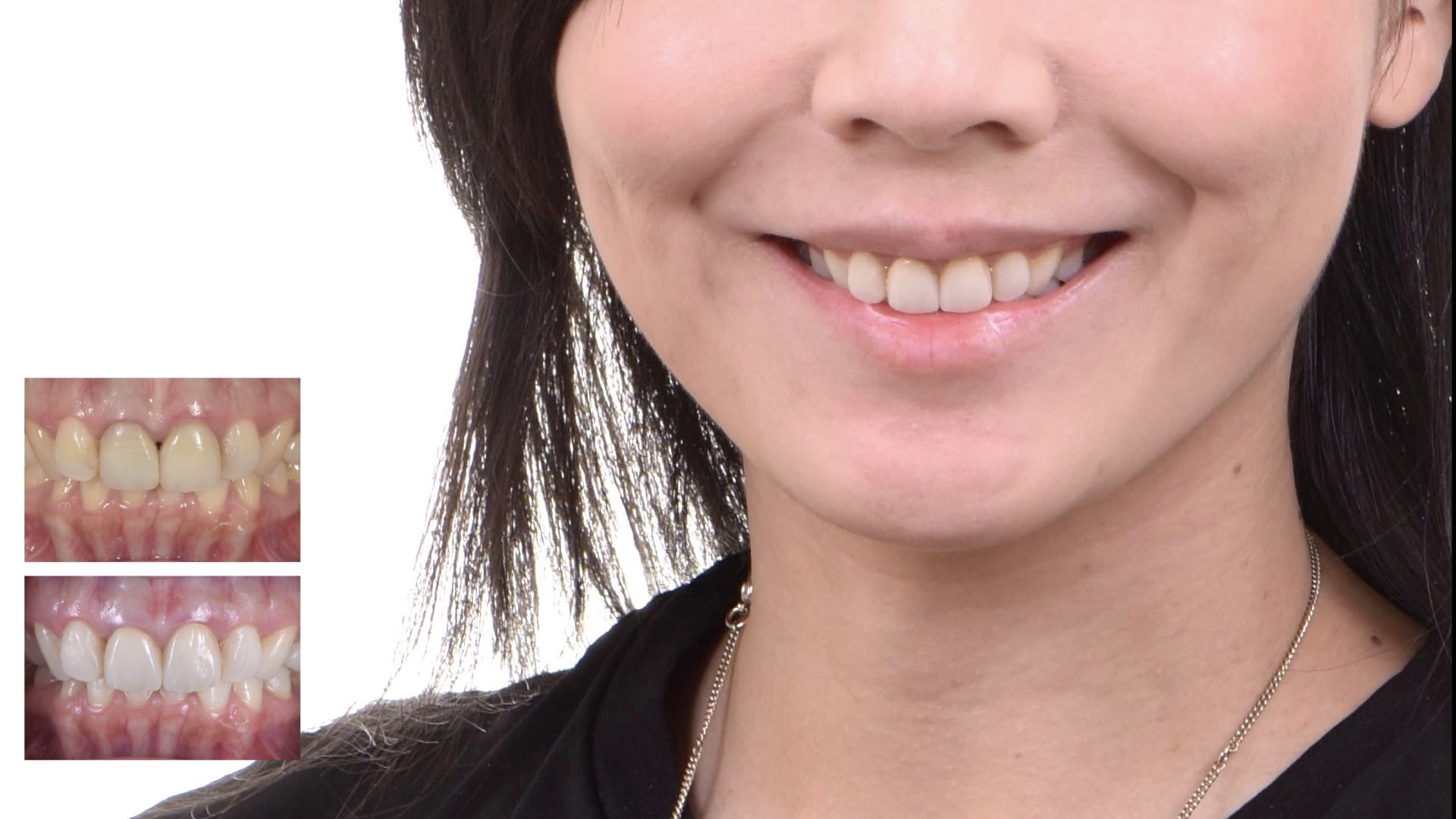 牙齒變黑了怎麼辦？part III：瓷牙顏色不自然，跟旁邊的牙齒顏色不同。