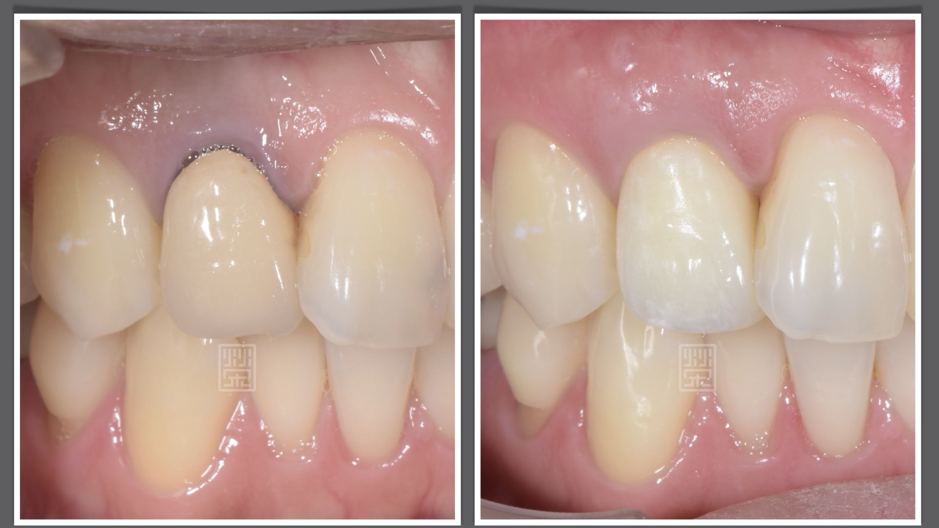牙齒變黑了怎麼辦？part V：牙根變色，但內有個大鑄釘，拿下來牙根傷害太大