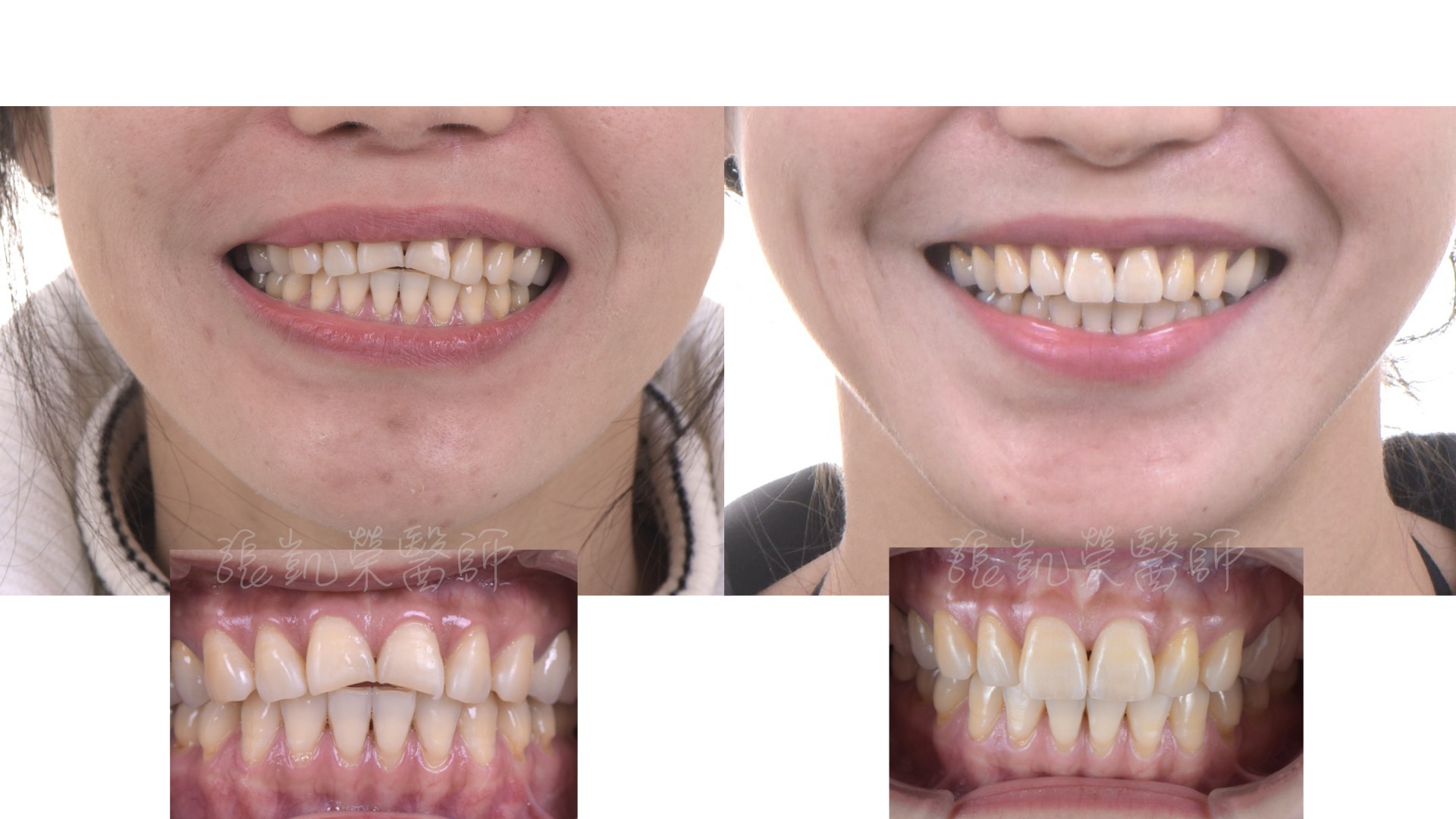 磨牙可不可以做貼片呢？