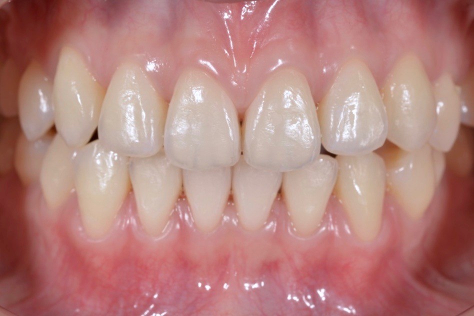 美白後牙齒怎麼還會有點黃黃的？