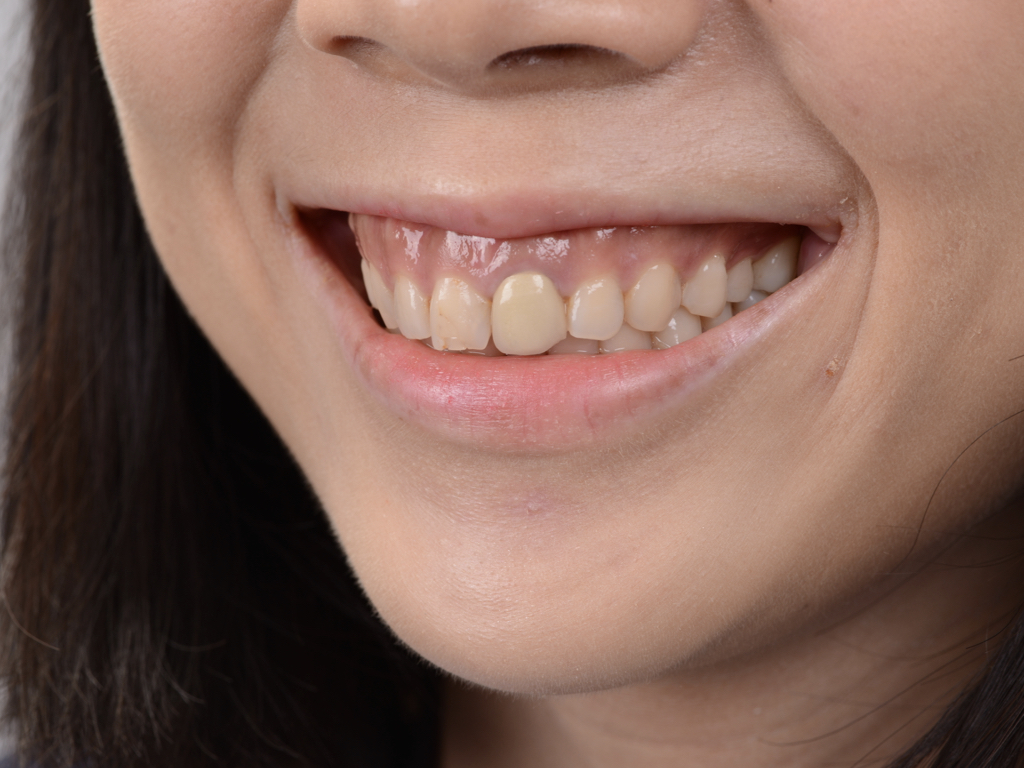 牙齦露出多、假牙不美觀