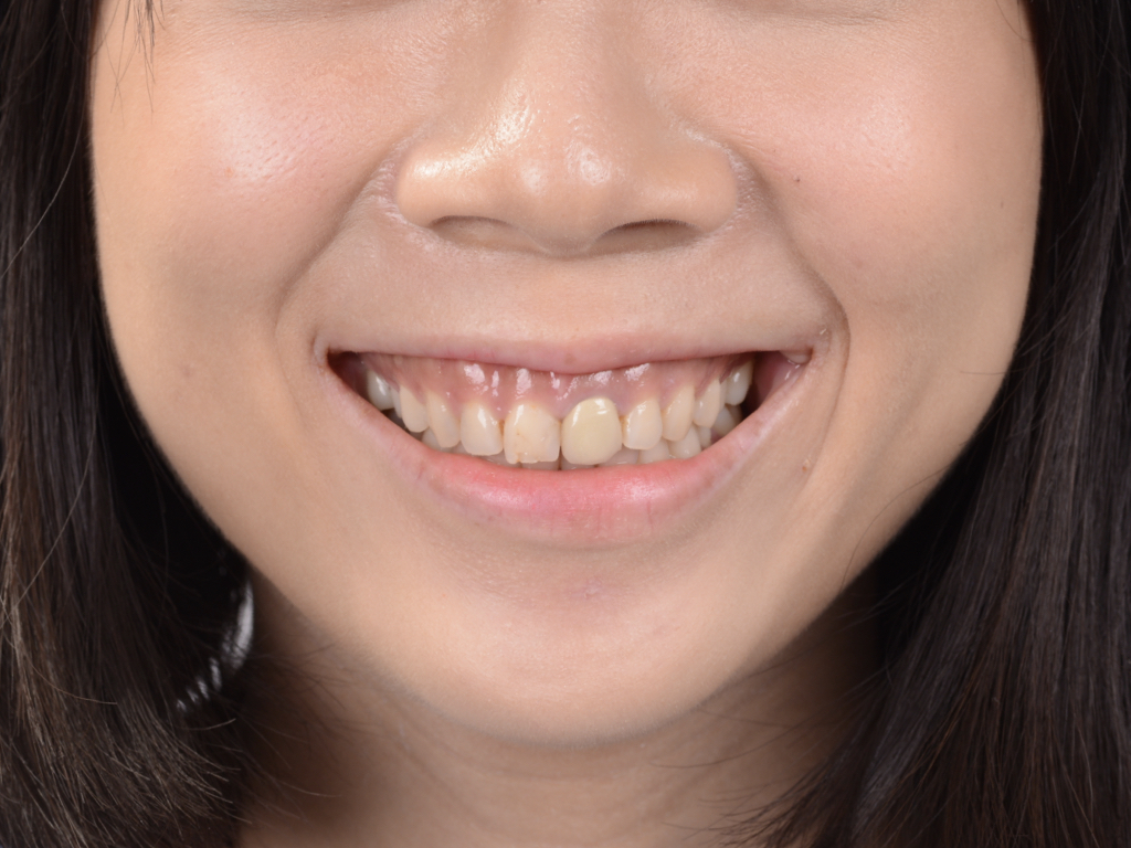 治療前正面紀錄