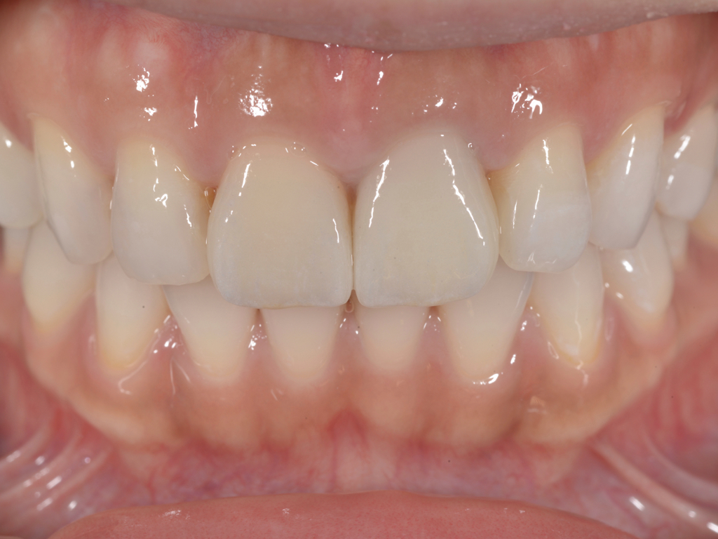 貼片與全瓷冠完成