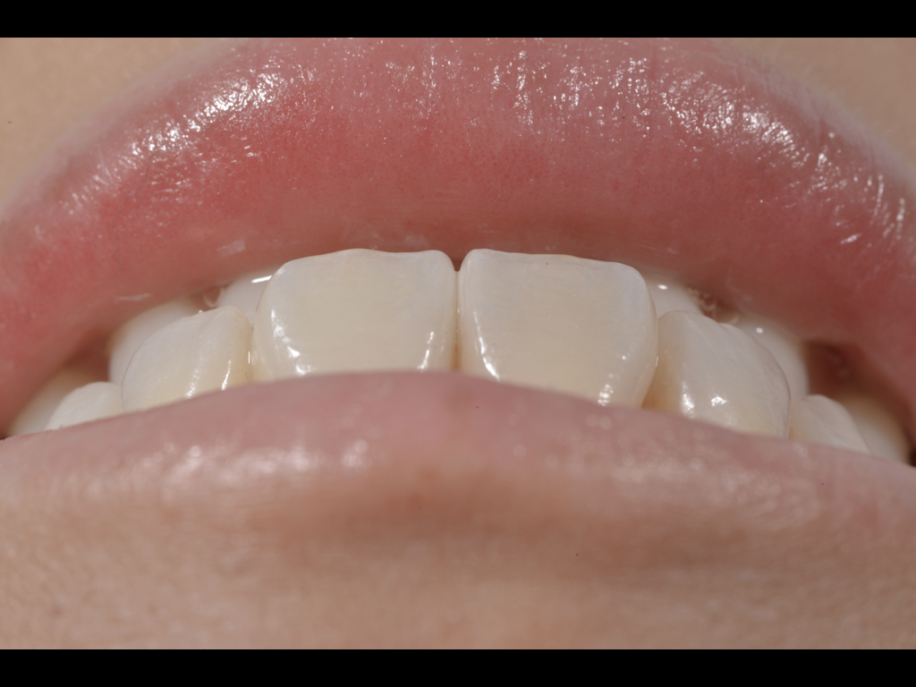 貼片與全瓷冠完成