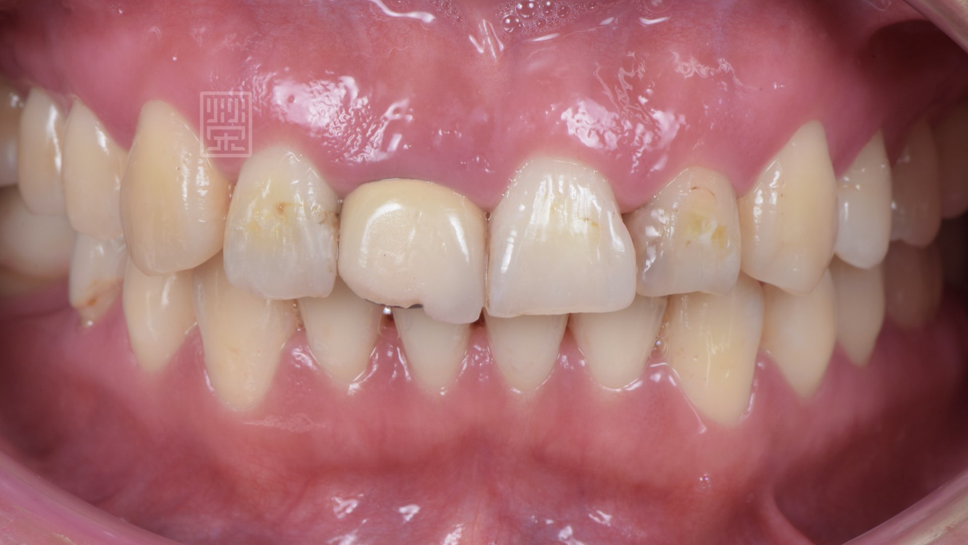 牙齦高低不一，填補樹脂變色，牙齒切端磨損