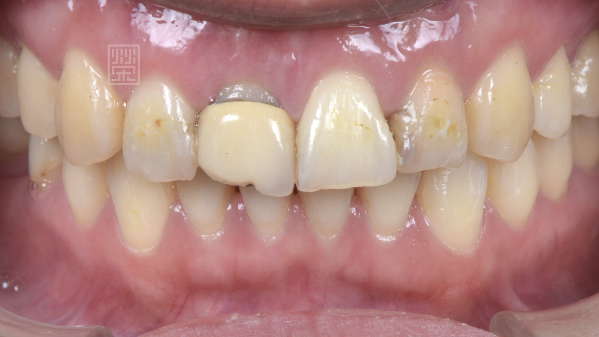 牙齦恢復後準備做牙齒美白