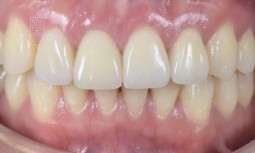 舊假牙大小不一，樹脂變色，牙齦高度不一致怎麼辦呢？------牙冠增長術與牙齒美白後，全瓷冠與貼片修復
