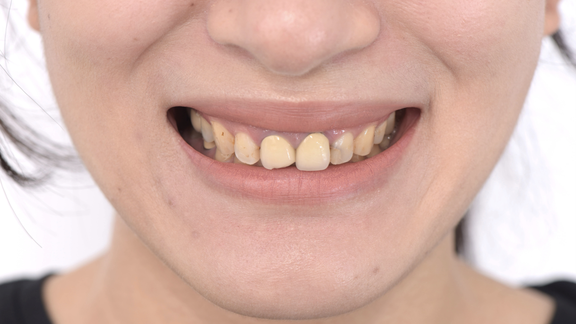 假牙破裂，邊緣有黑色邊