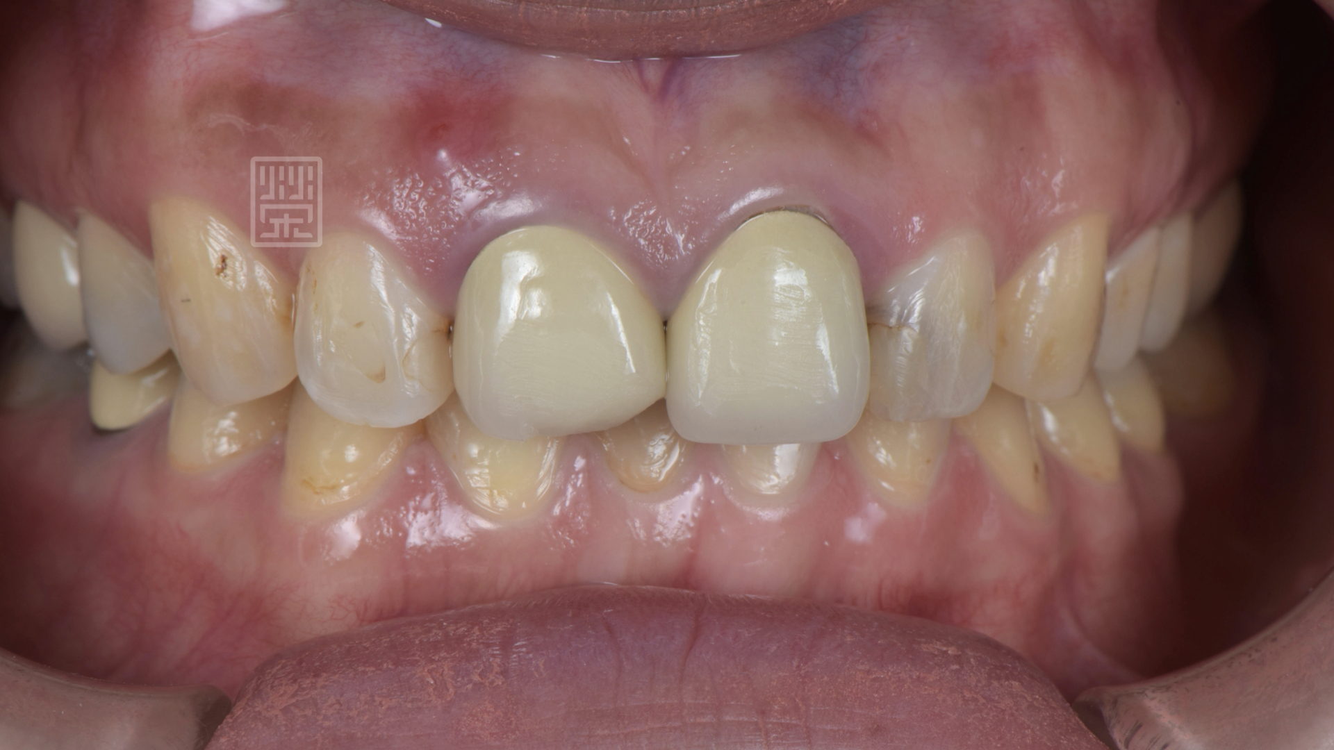 右邊中門牙牙齦腫起來