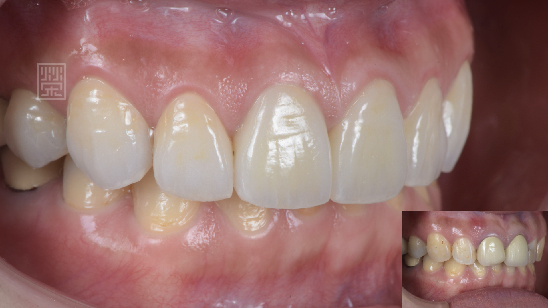 植牙、全瓷冠、全瓷貼片完成
