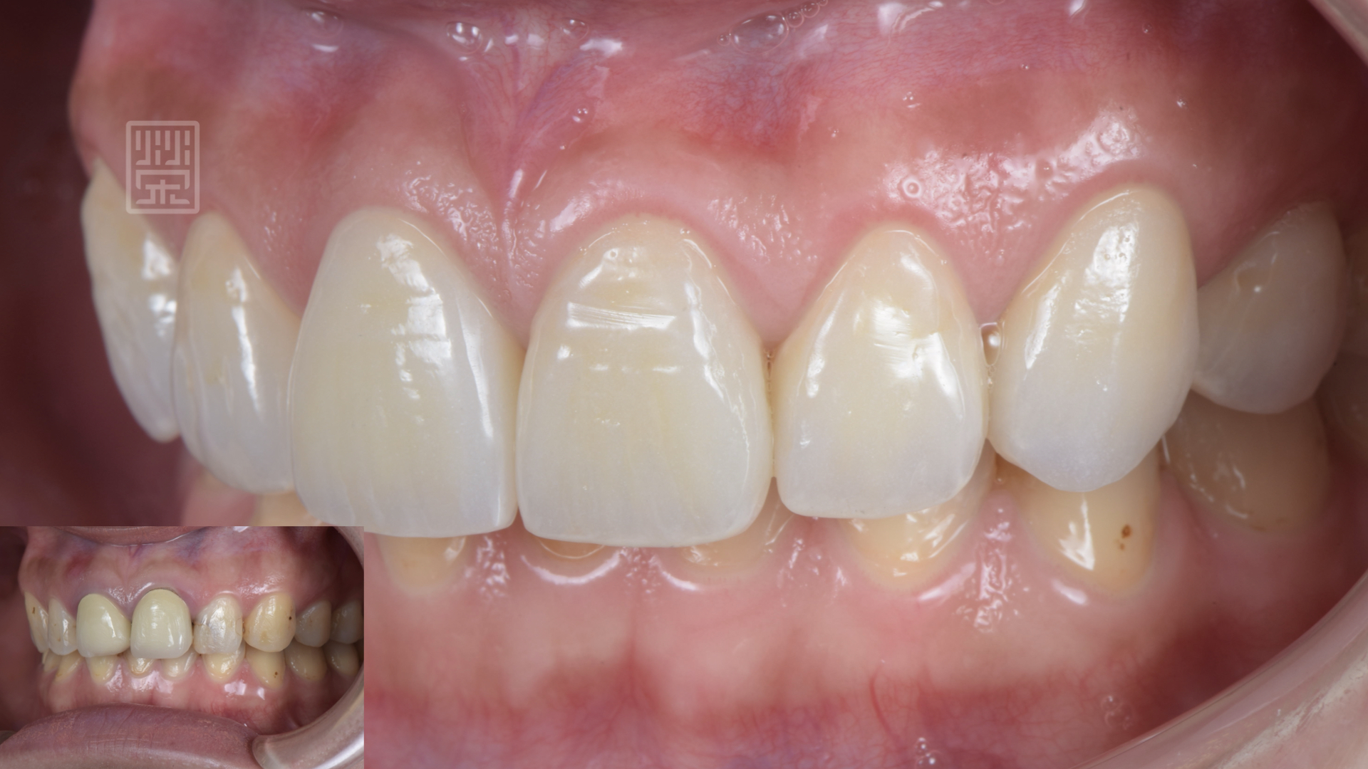 植牙、全瓷冠、全瓷貼片完成