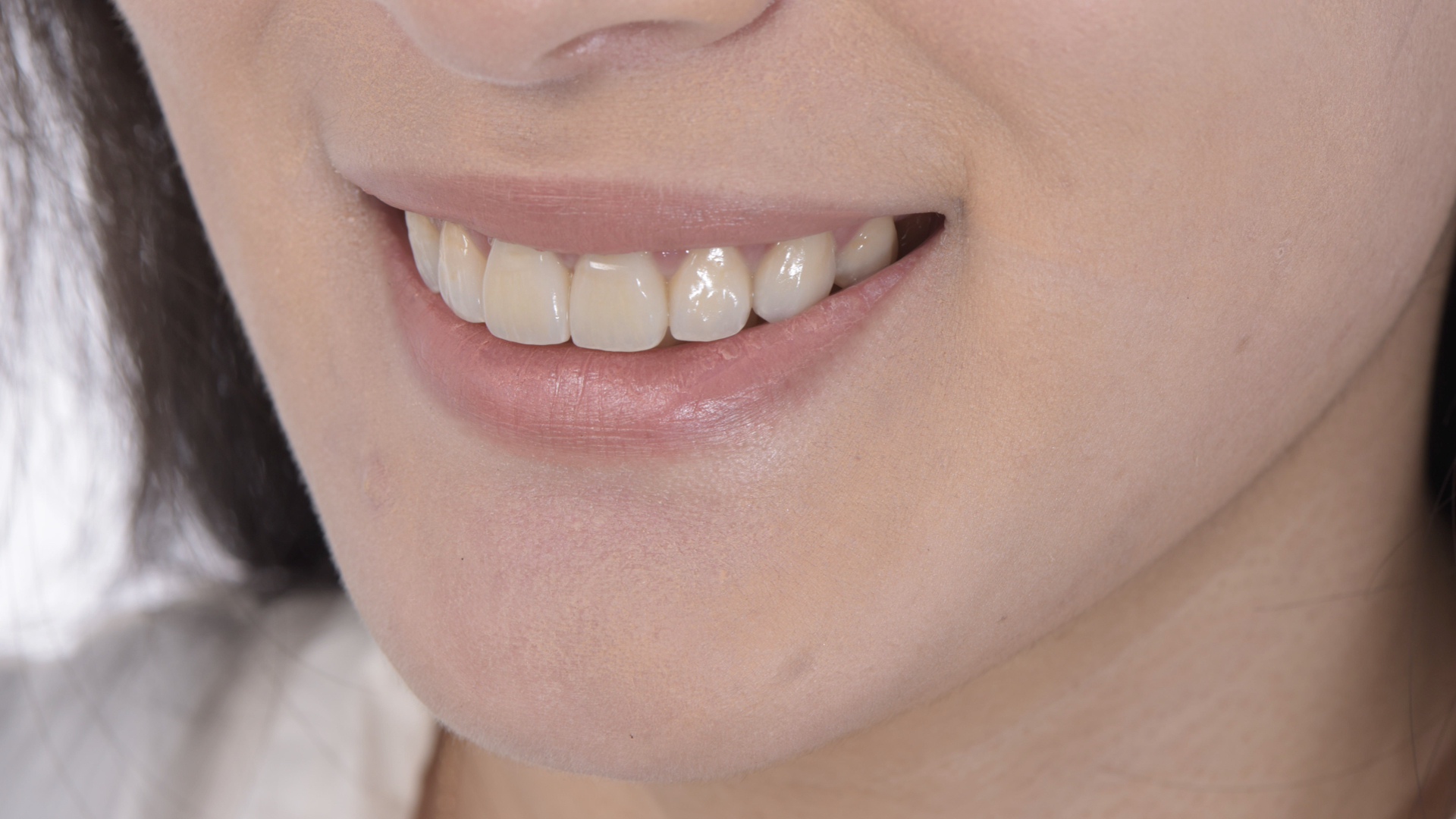 貼片全瓷冠與笑容和諧