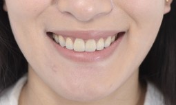 我的舊假牙破了，邊緣有黑邊，而且牙齦還腫起來怎麼辦？------植牙、全瓷冠、貼片治療