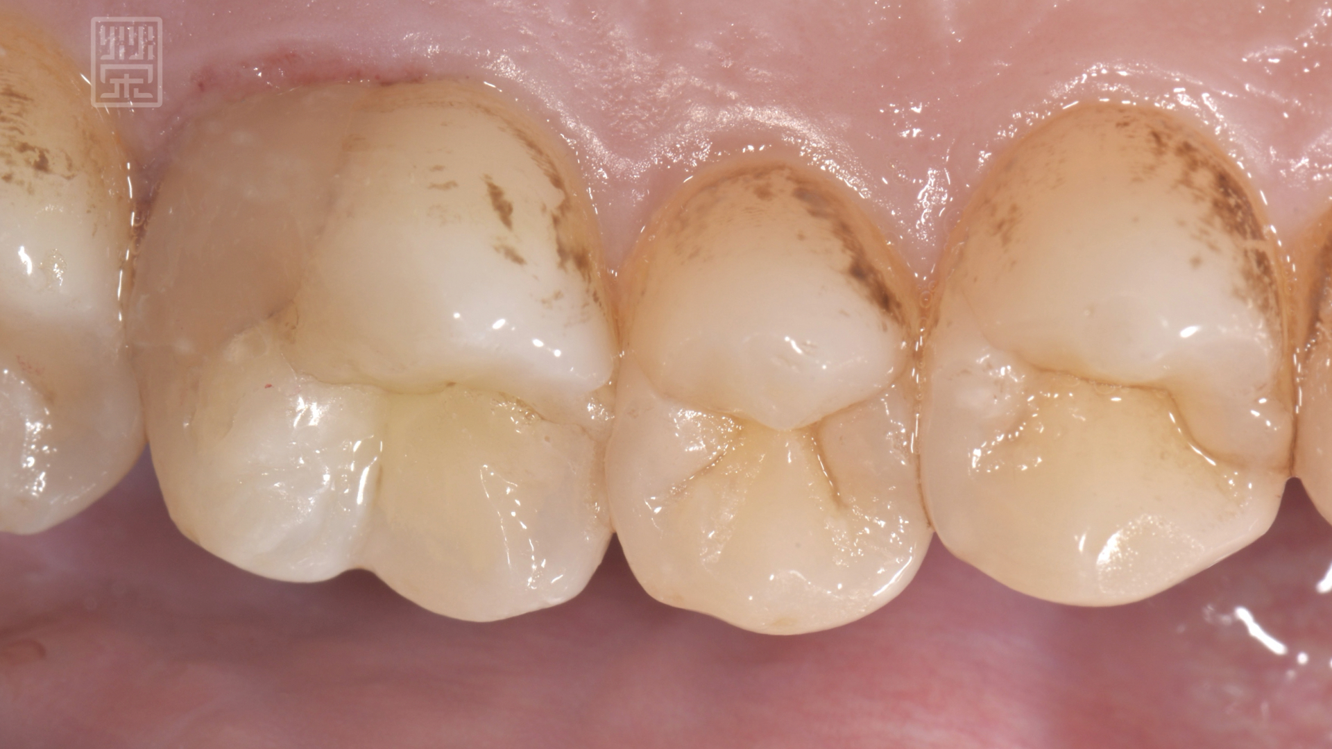 牙齒裂開後他院樹脂填補