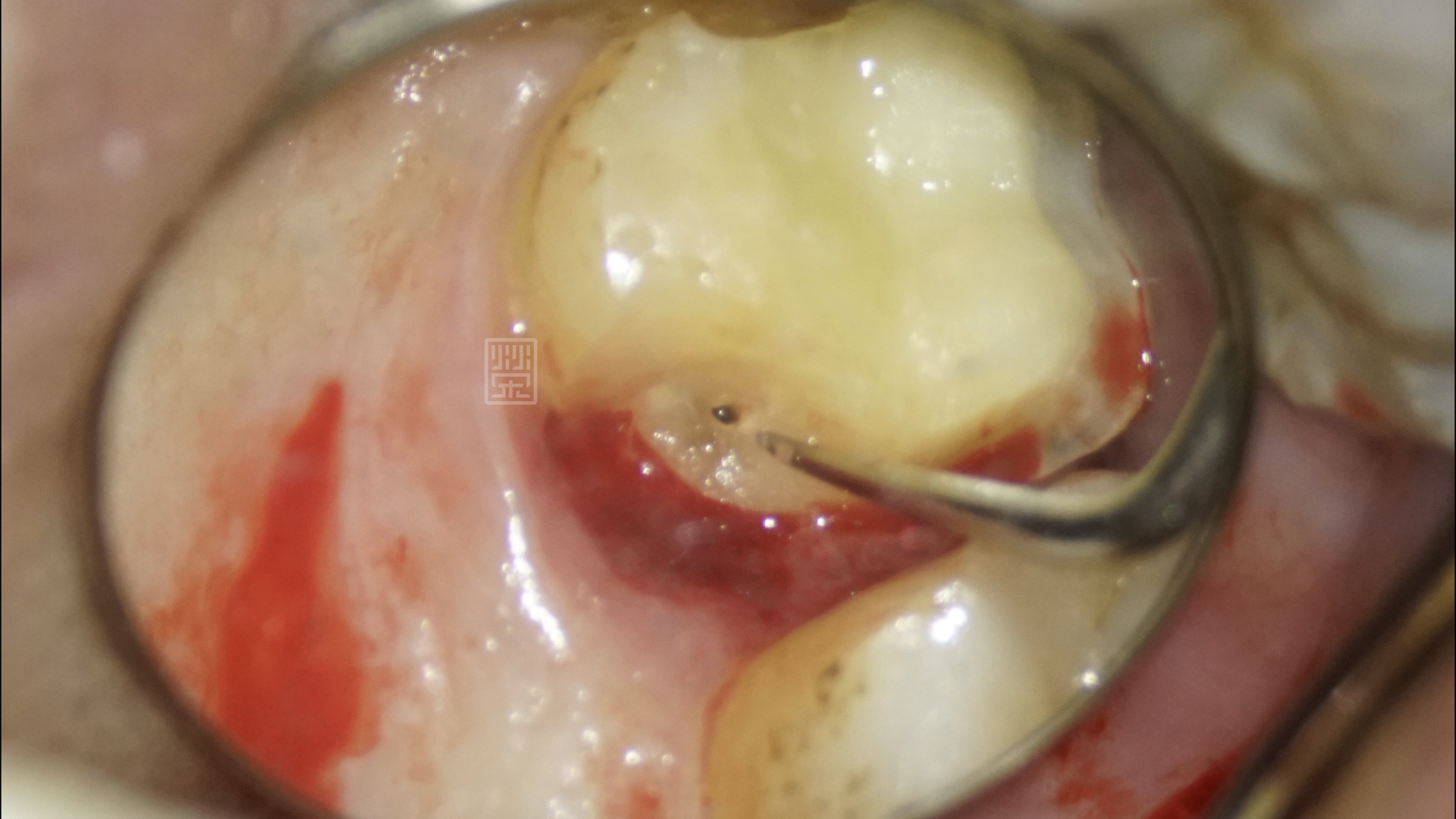 牙冠增長術將邊緣裸露出，以利全瓷嵌體邊緣製作