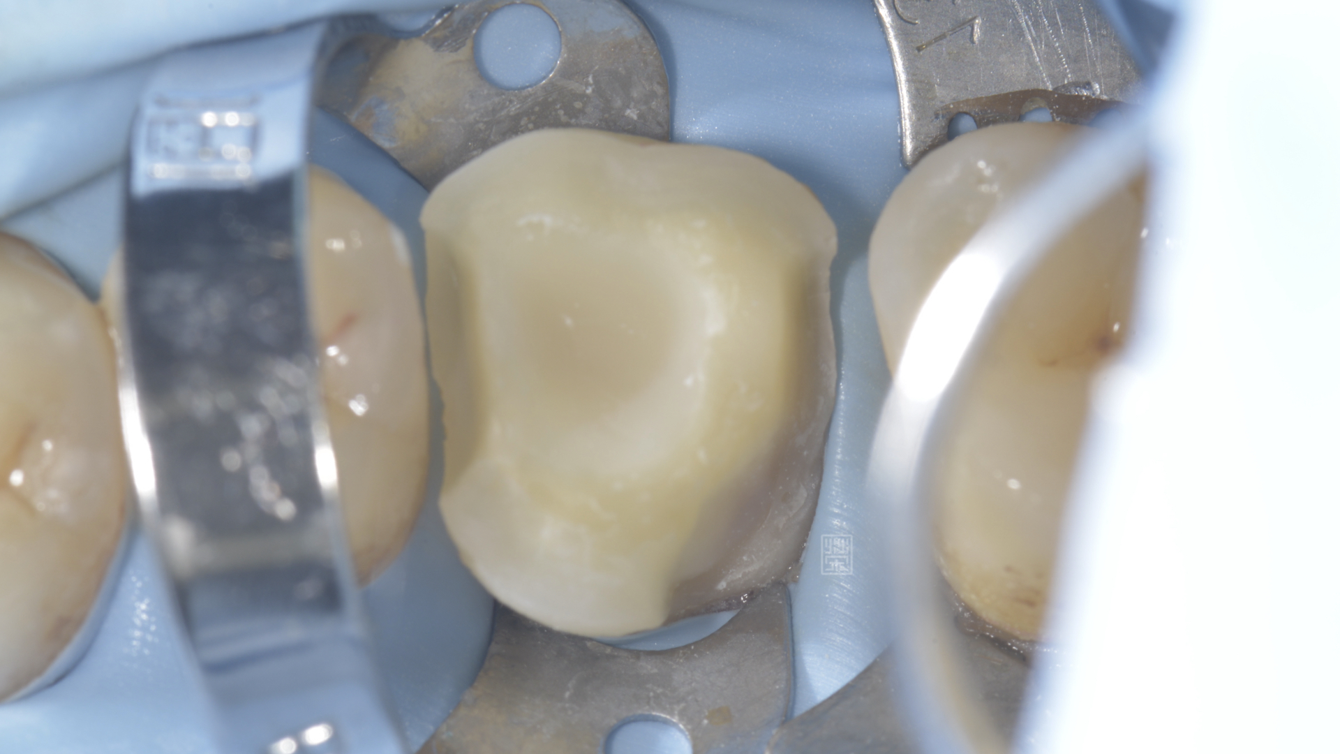 根管治療後，將邊緣修順，給全瓷嵌體走夠的空間