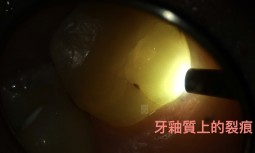 牙齒咬起來怪怪的，有點不舒服------牙齒裂痕，造成牙髓壞死，顯微根管與全瓷嵌體修復
