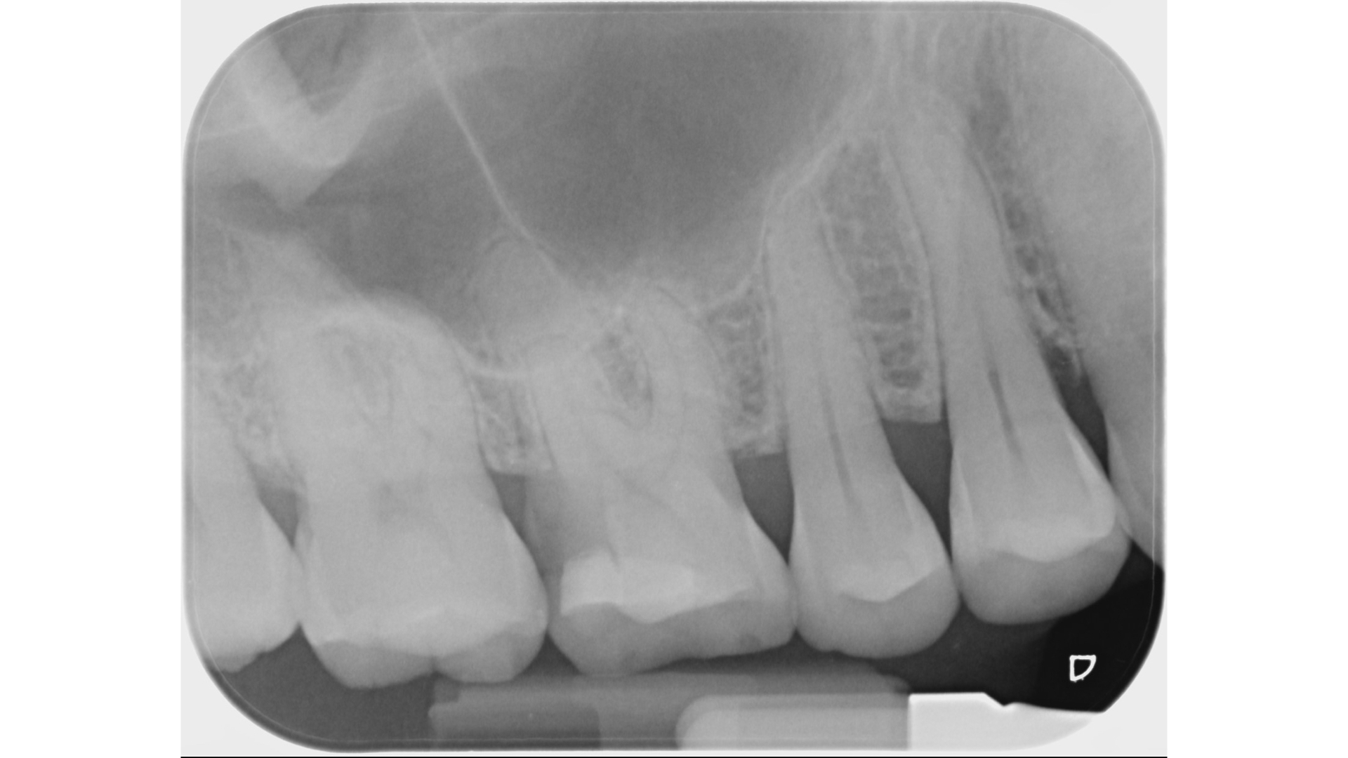 Ｘ光發現裂痕延伸到接近骨頭