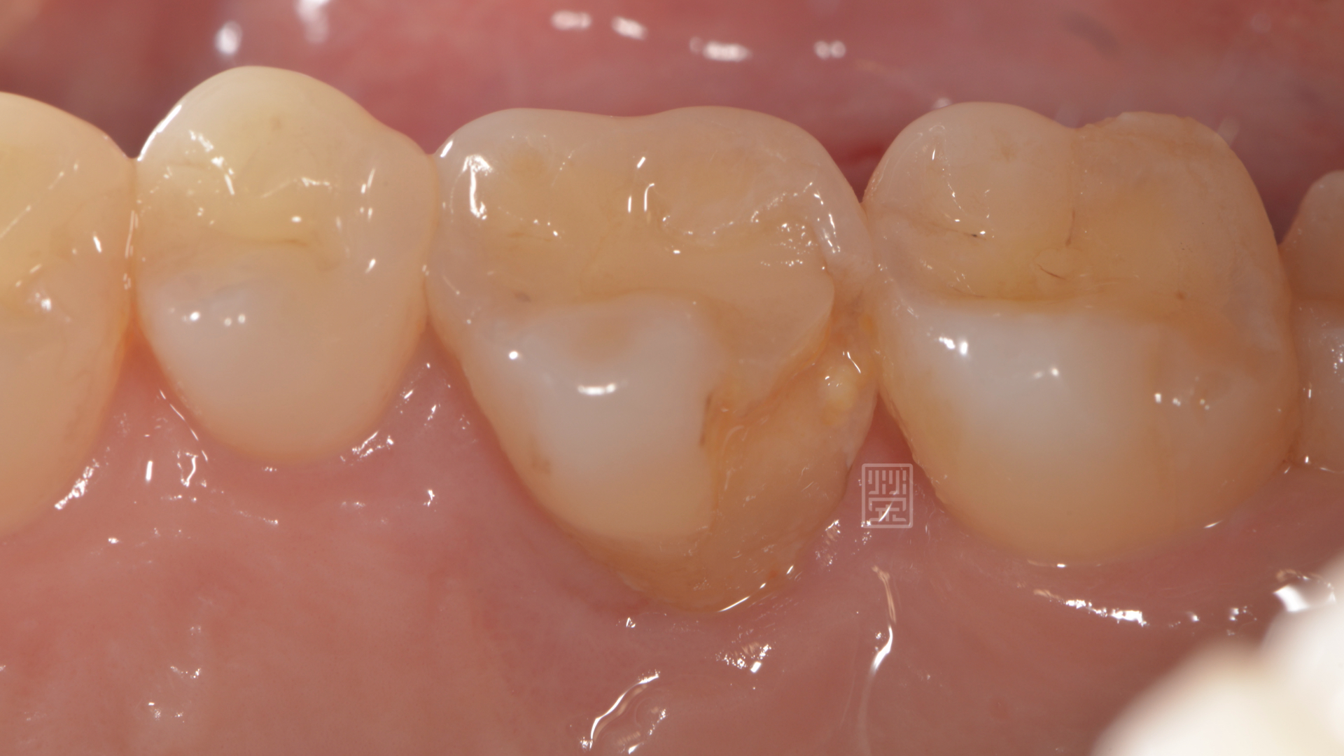 牙冠增長術後將牙齒邊緣獨立出來