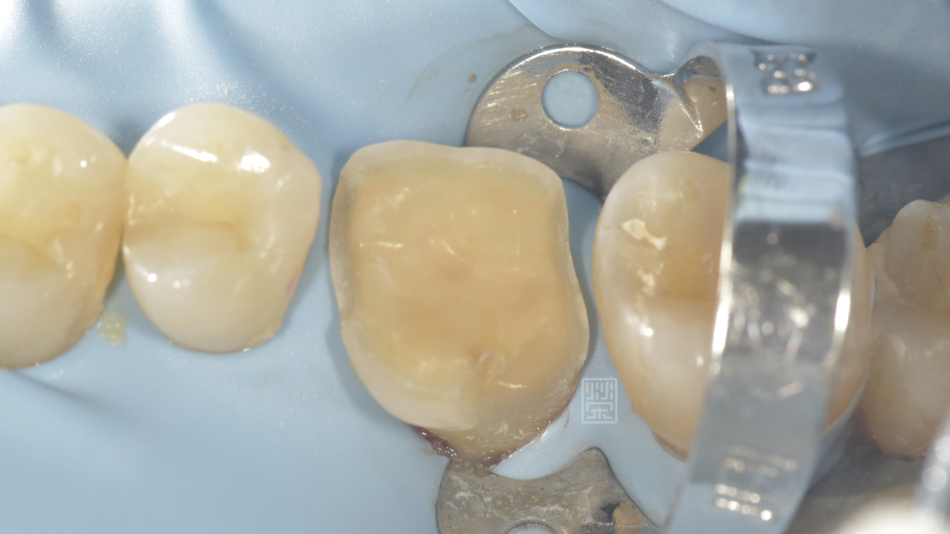 牙齒邊緣修行，給全瓷嵌體足夠空間