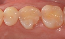 我的牙齒咬破了，感覺牙齦有點痛痛的-----牙冠增長術後，全瓷嵌體修復