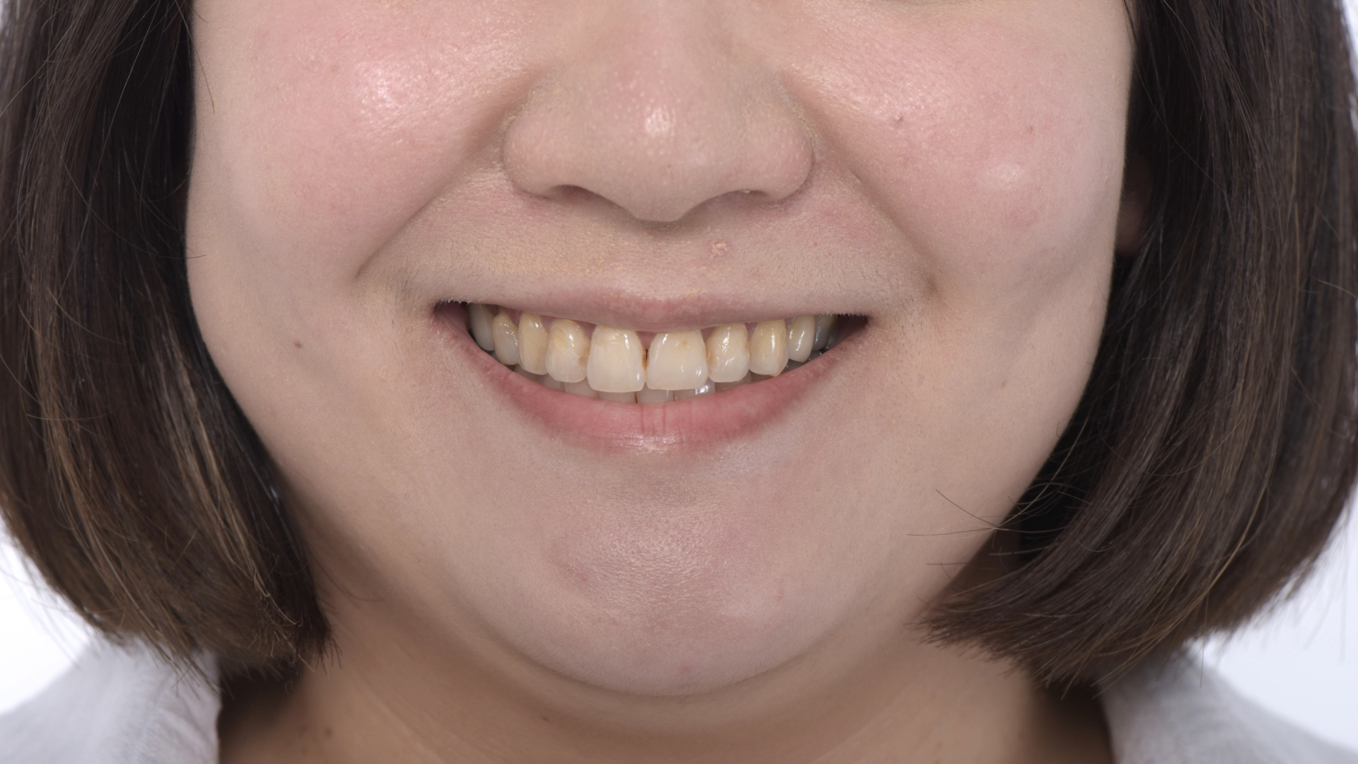 門牙稍微長短不一，齒色不是非常亮白