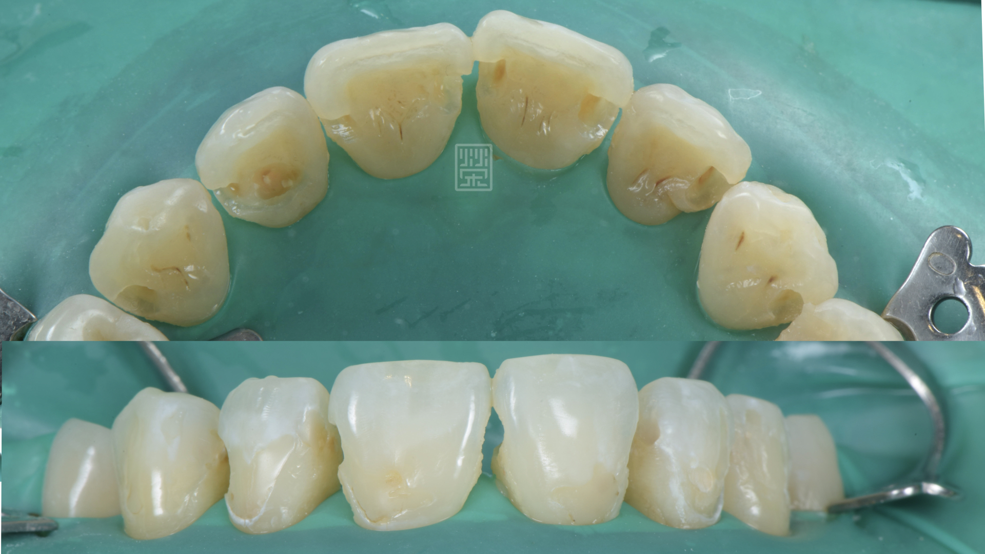 矯正前先把蛀牙與舊天補物清除，確認齲齒病灶已經治療完成