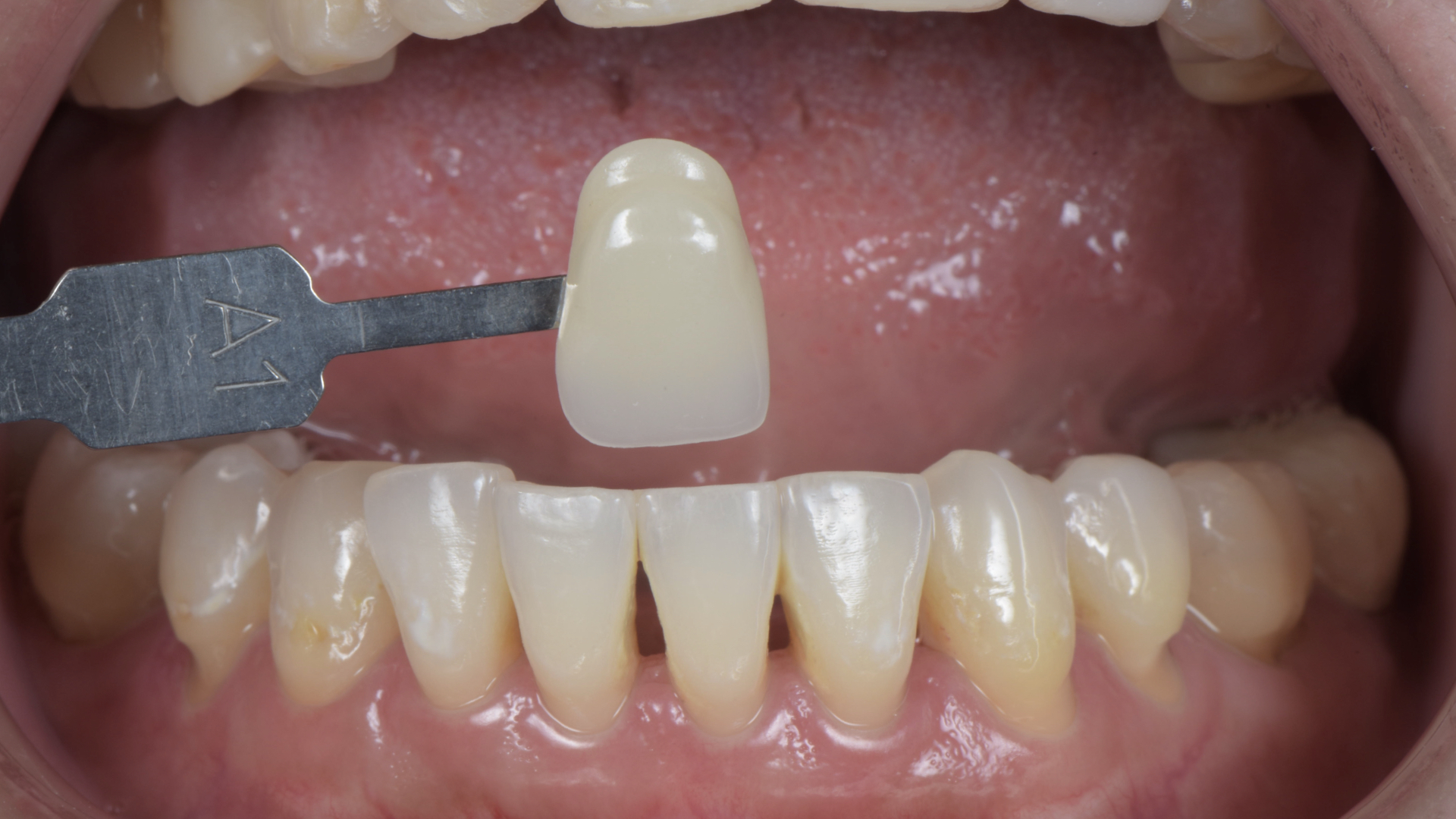 參考下顎牙齒顏色作為上顎貼片的參考