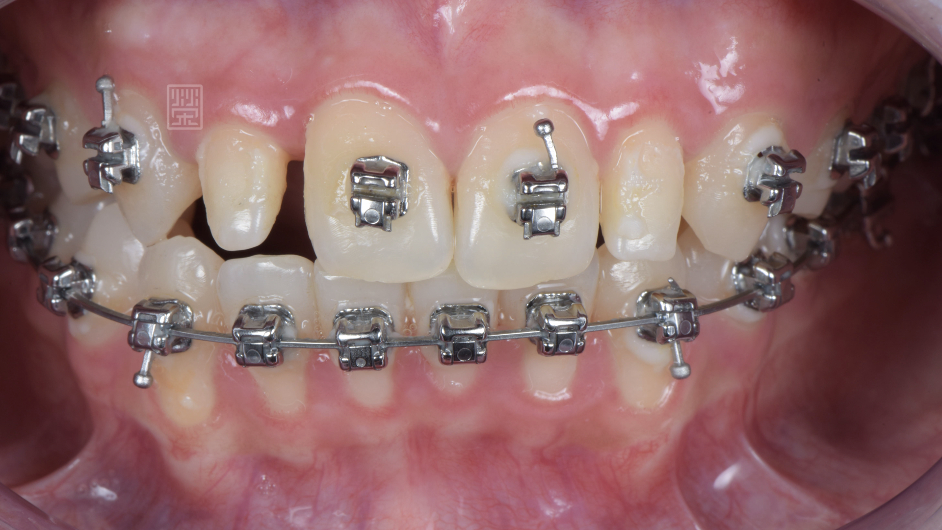 側門牙偏小，矯正醫師將空間保留下來