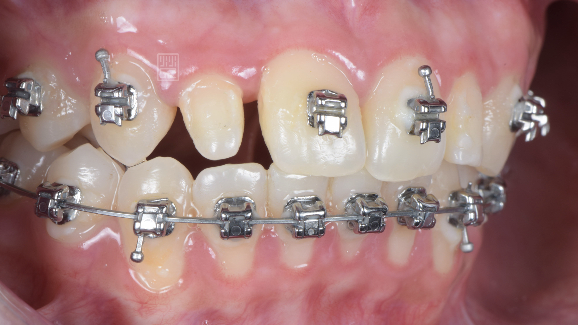 側門牙偏小，矯正醫師將空間保留下來