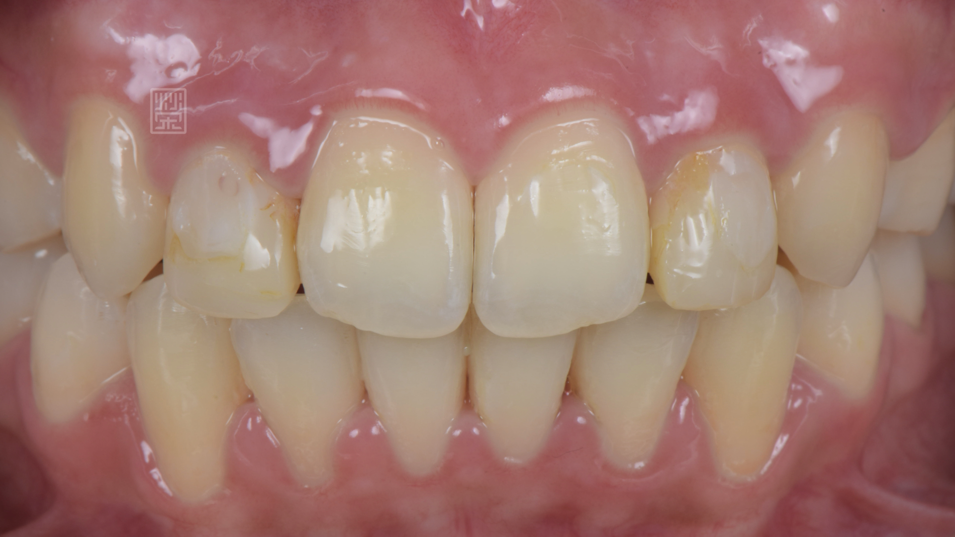 側門牙偏小，矯正醫師將空間保留下來