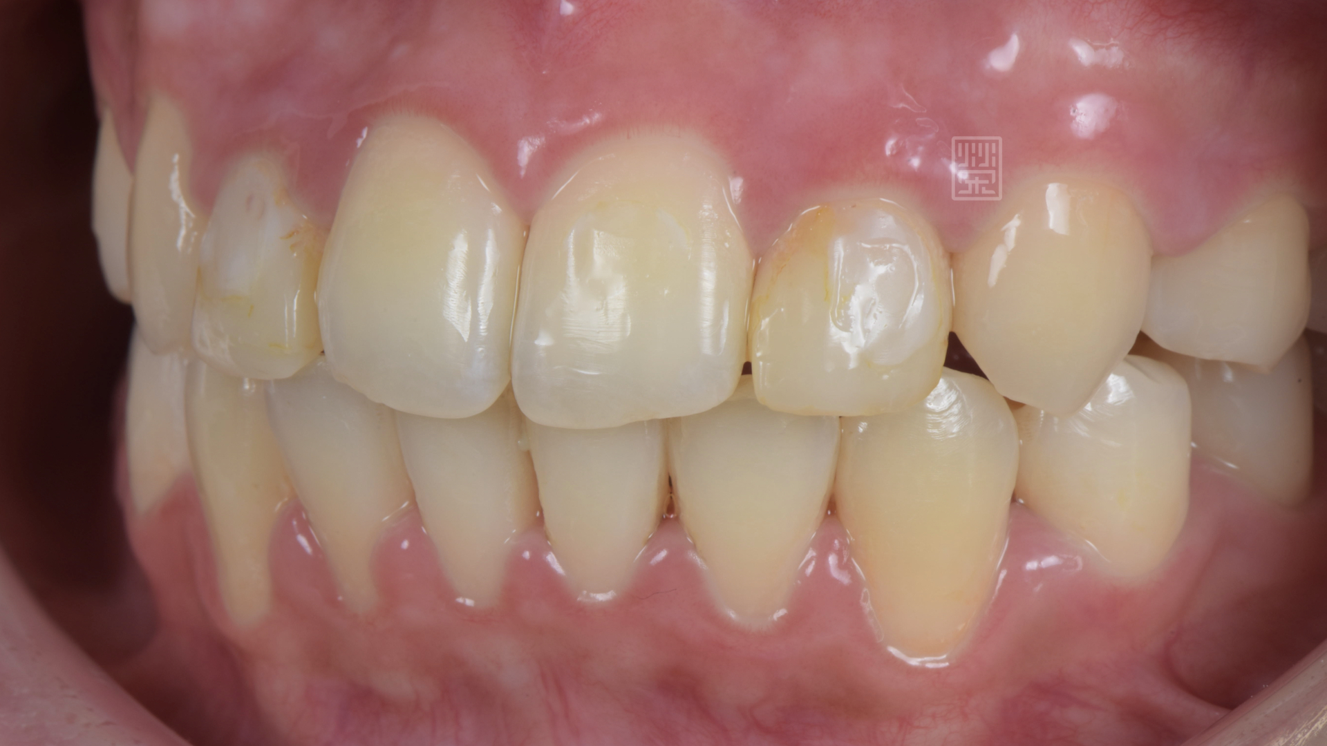側門牙偏小，矯正醫師將空間保留下來