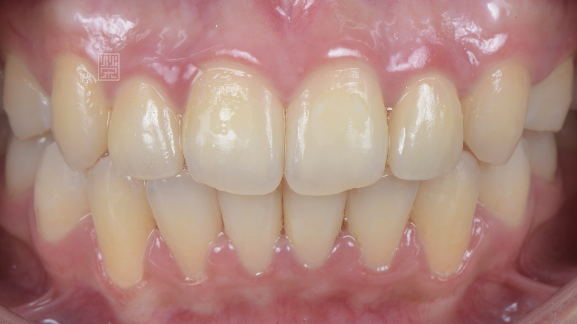 側門牙全瓷冠完成