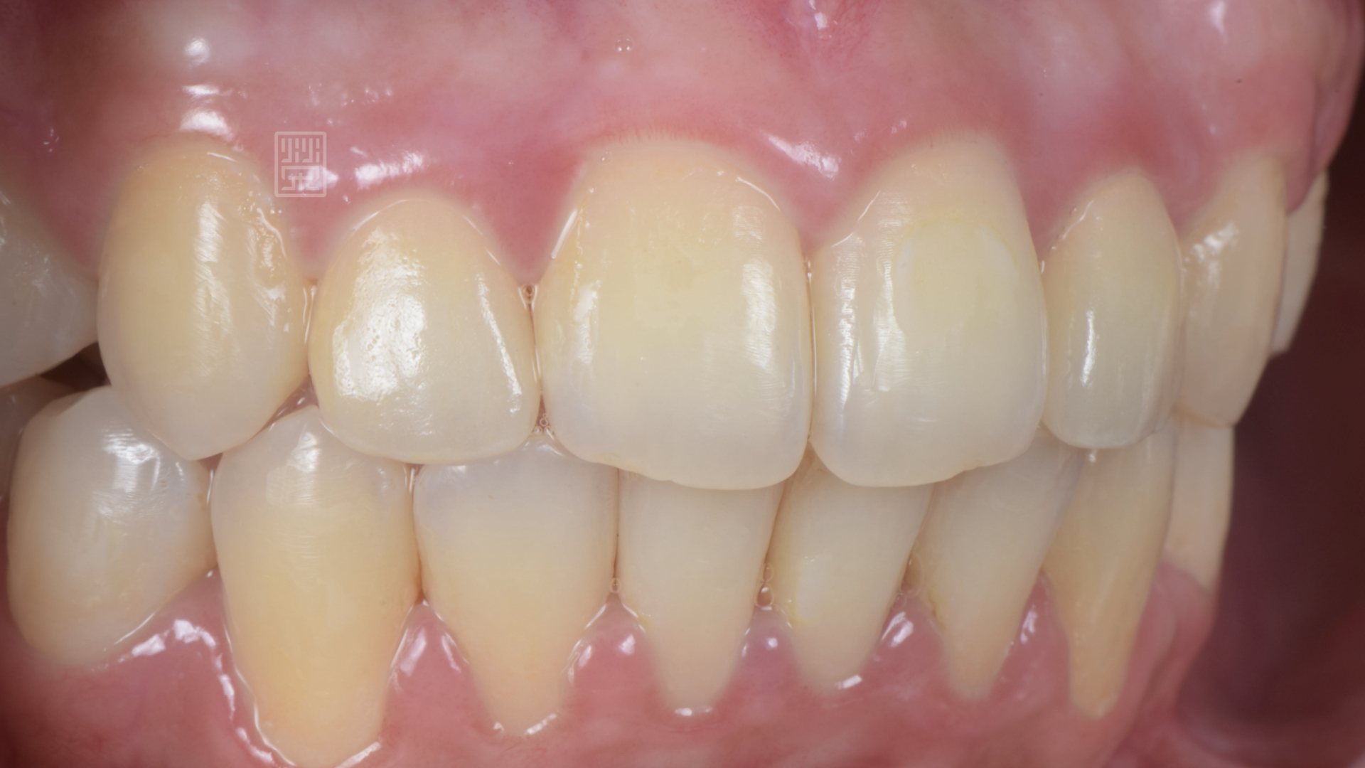 側門牙全瓷冠完成