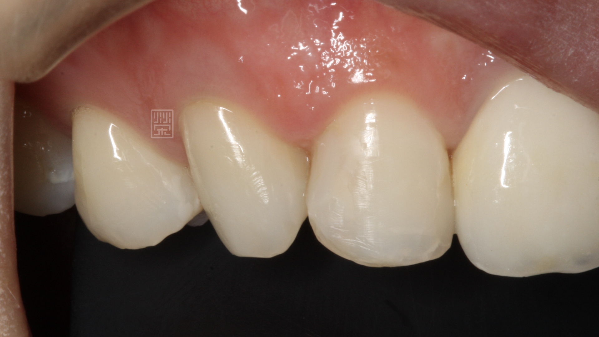 根管治療後尺內美白，讓牙齒顏色恢復原本色階