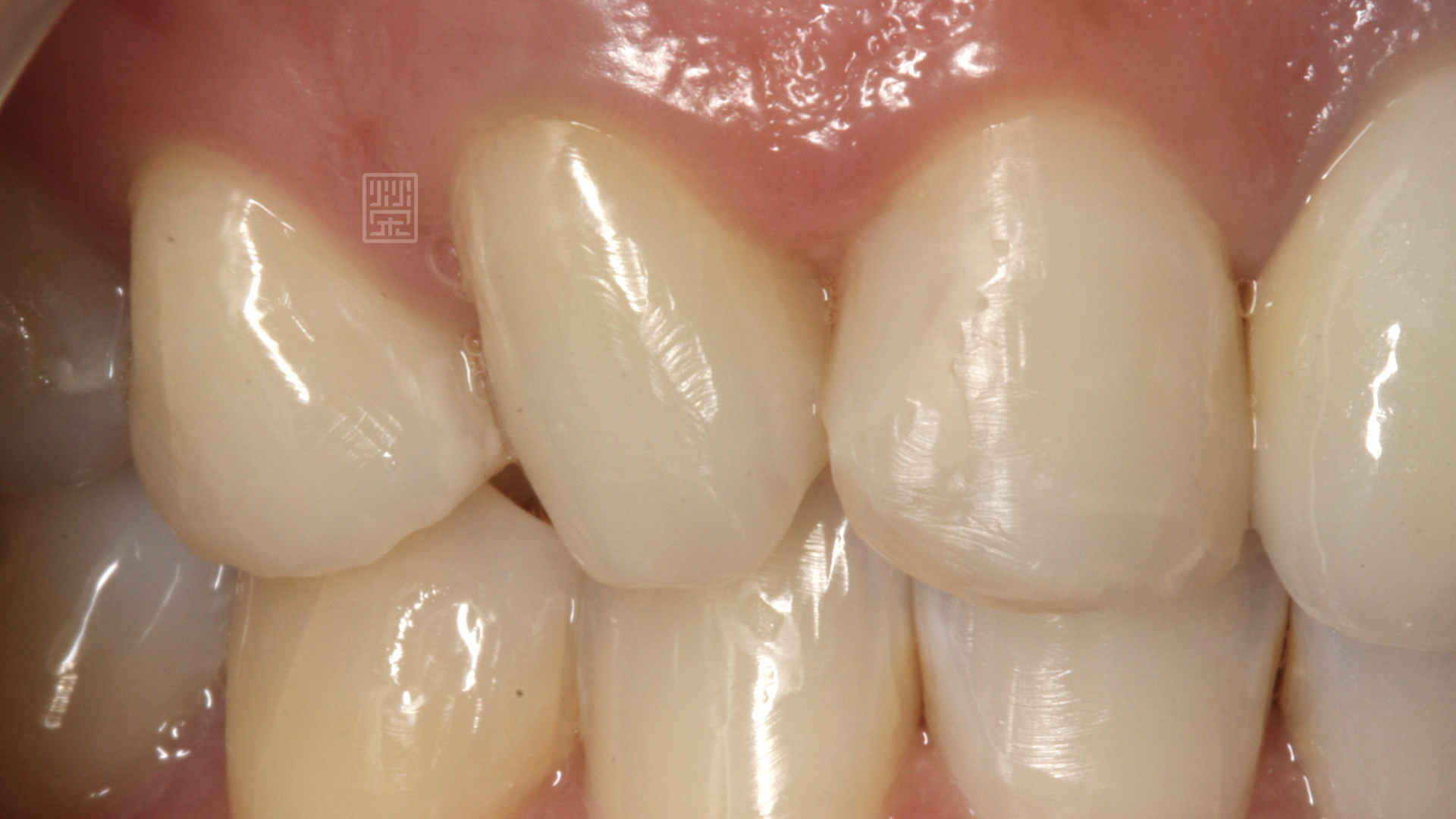 齒內美白後，與鄰牙對側牙顏色和諧