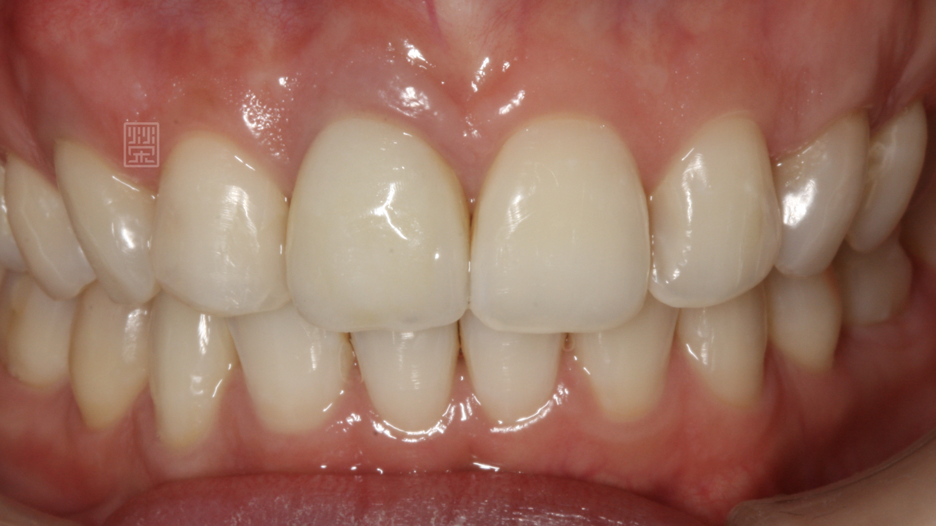 齒內美白後，讓整體顏色恢復和諧狀態