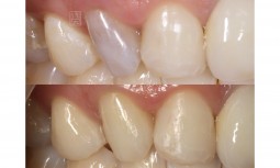 榮醫師！！！我的牙齒圖然變黑了怎麼辦？------根管治療與尺內美白