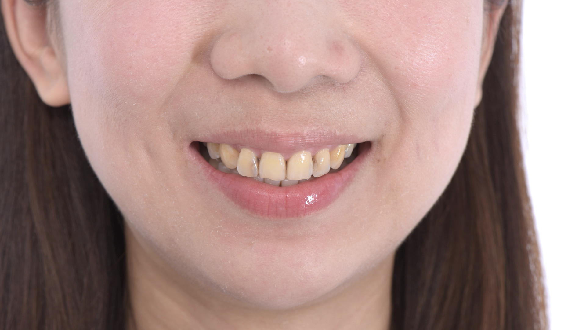 微笑時，門牙四顆切端略平