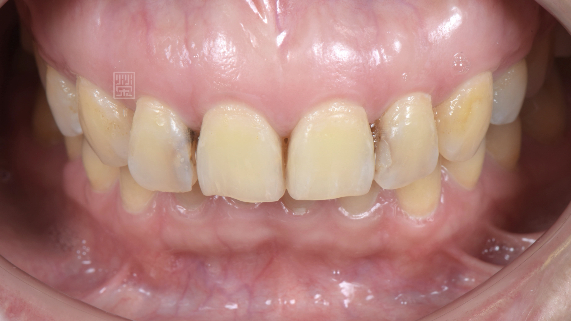 門牙長寬比例約為90%，理想應達到75~80%之間