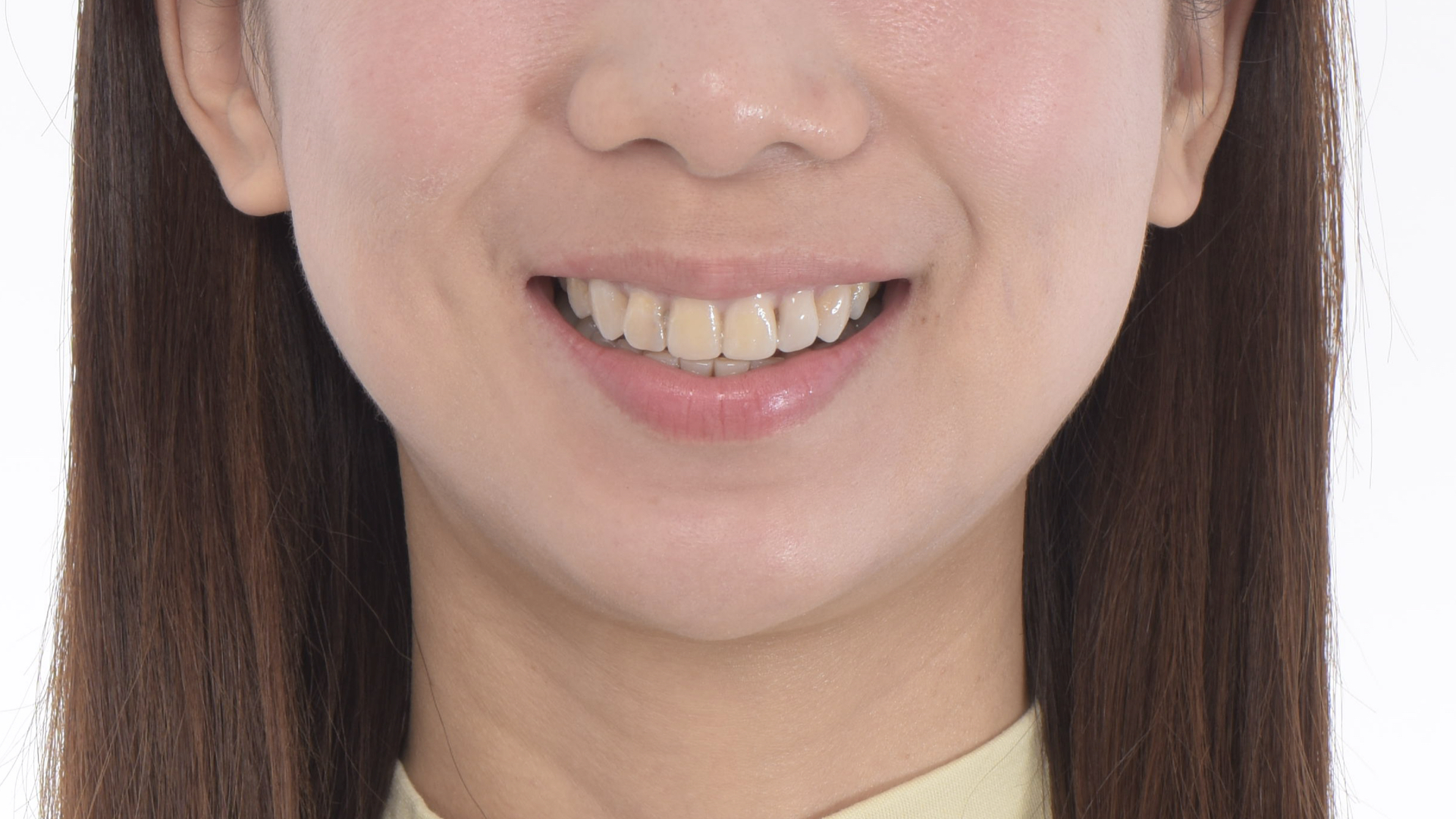 數位微笑模擬，溝通門牙長度，讓微笑曲線設計更好溝通