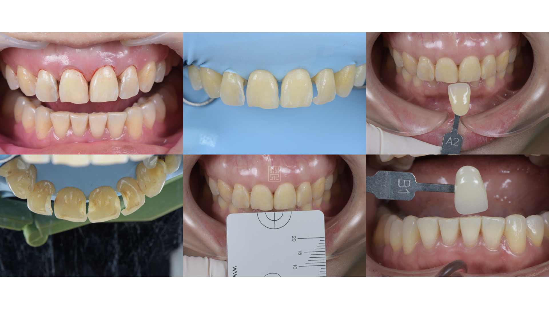 治療步驟，包含牙冠增長術、去除舊填補物與蛀牙、牙齒美白、比色