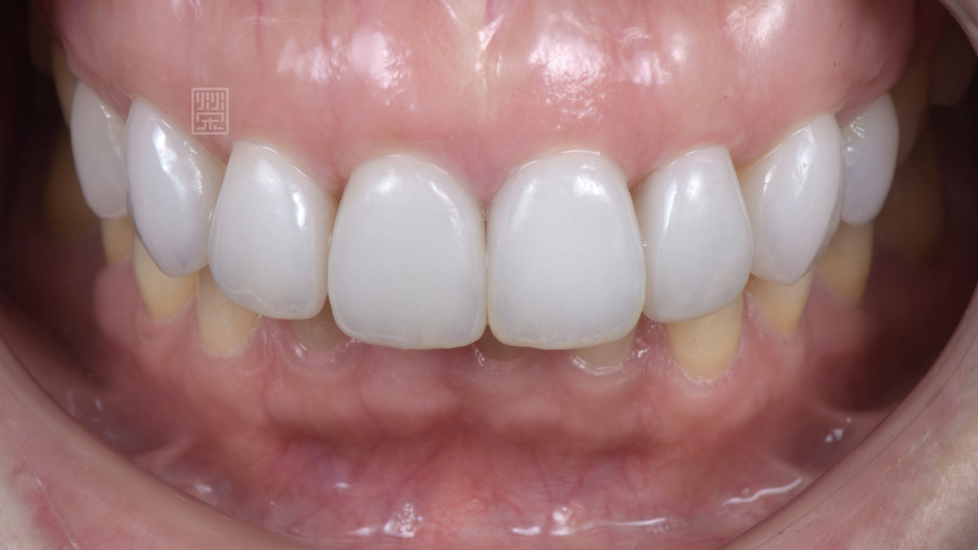 全瓷冠貼片完成