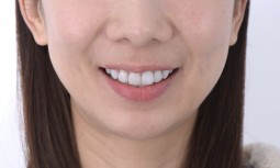 榮醫師，我覺得我的門牙平平的，而且顏色偏黃，該怎麼辦呢？------牙冠增長術與全瓷貼片