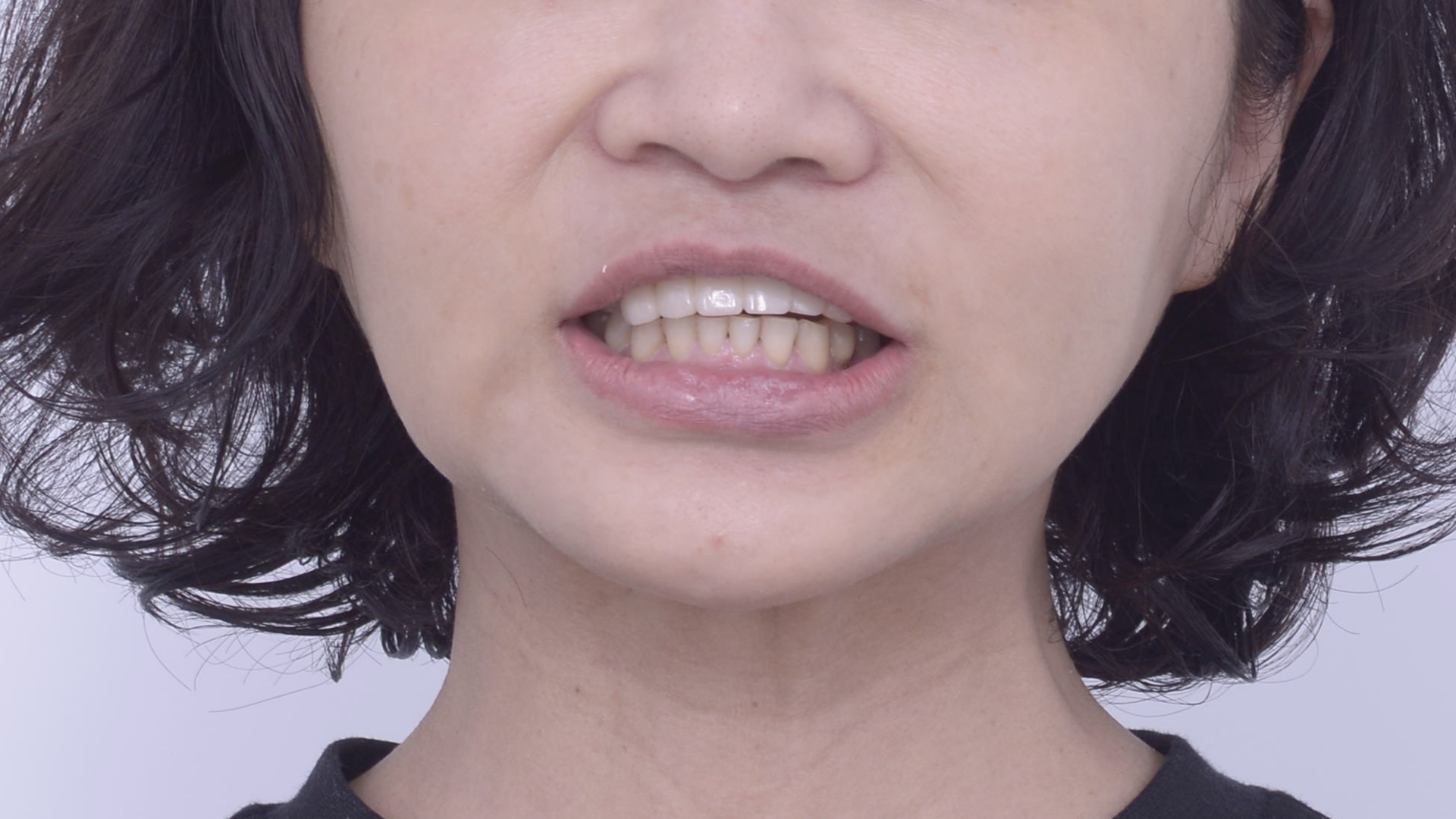 門牙牙齒歪斜，連笑都不敢太大力，怕牙齒會鬆脫